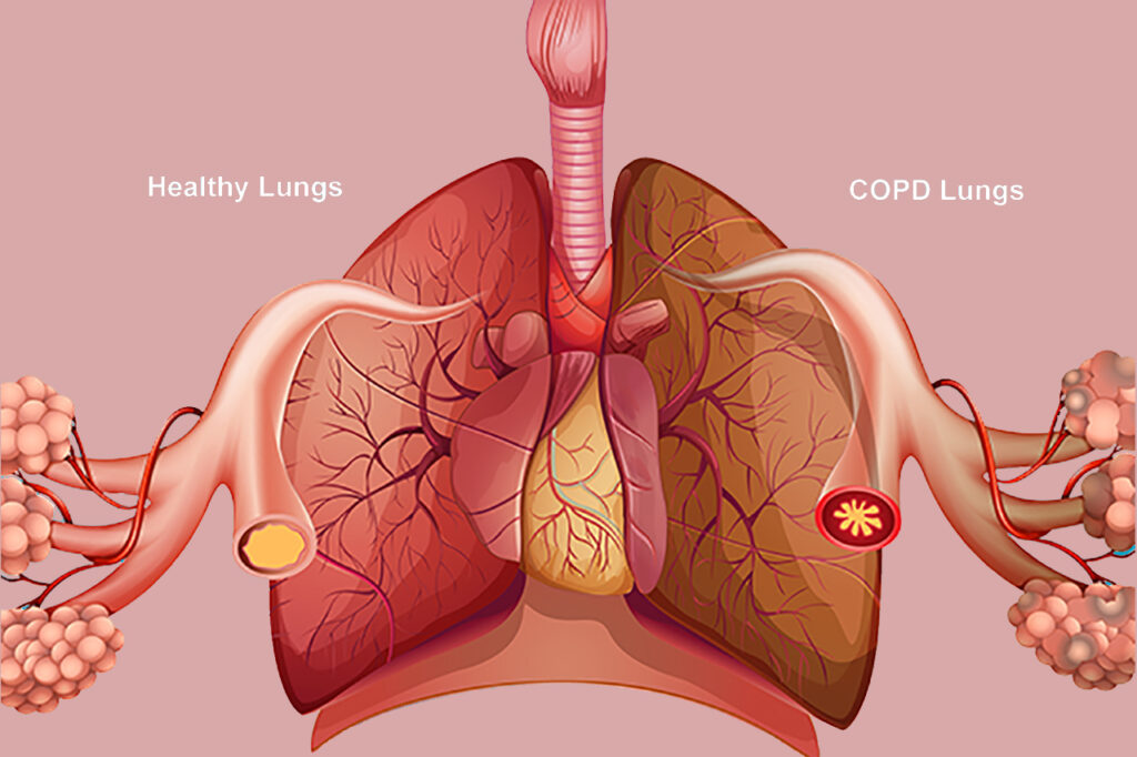COPD- Chronic obstructive pulmonary disease- Dr. Apar Agarwal
